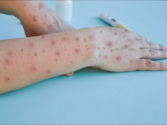 मंकीपॉक्स: जागतिक स्तरावर वाढणारा संसर्गजन्य रोग